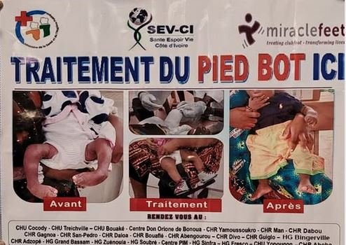 L'EPHR d'Aboisso dispose désormais d'une clinique spécialisée pour la prise en charge gratuite des pieds bots chez les enfants âgés de 0 à 2 ans